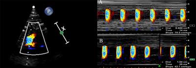 Non-Invasive Detection of Fetal Vascular Endothelial Function in Gestational Diabetes Mellitus